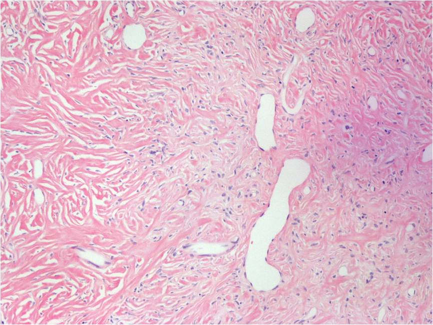 Low Grade Fibromyxoid Sarcoma 6651